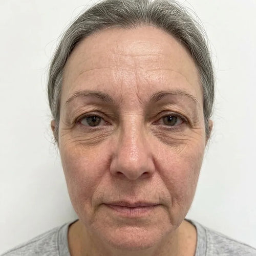 After Anti-aging results