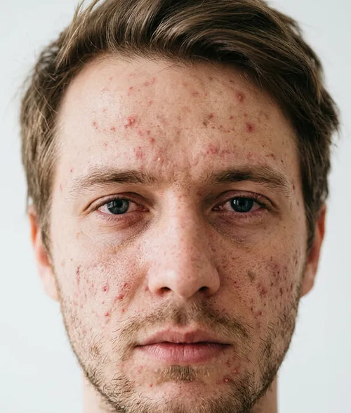 Before Skin rejuvenation