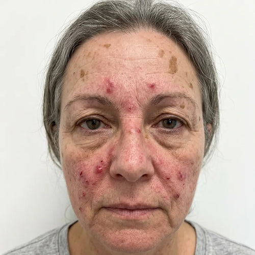 Before Anti-aging results