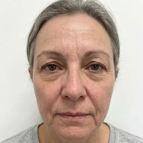 After Skin improvement